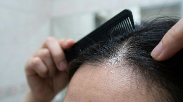 Dandruff or Dry Scalp: How to Tell